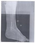 fractura de tibia y perone-2.jpg