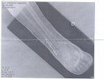 fractura de tibia y perone.jpg