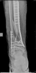 Fractura Tibia y peroné trasera 21 Agosto14.jpg