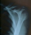 resized_radiografia clavicula.jpg